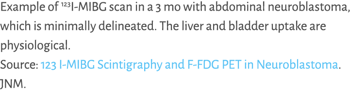 Example of 123I MIBG scan in a 3 mo with abdominal neuroblastoma, which is minimally delineated. The liver and bladde...