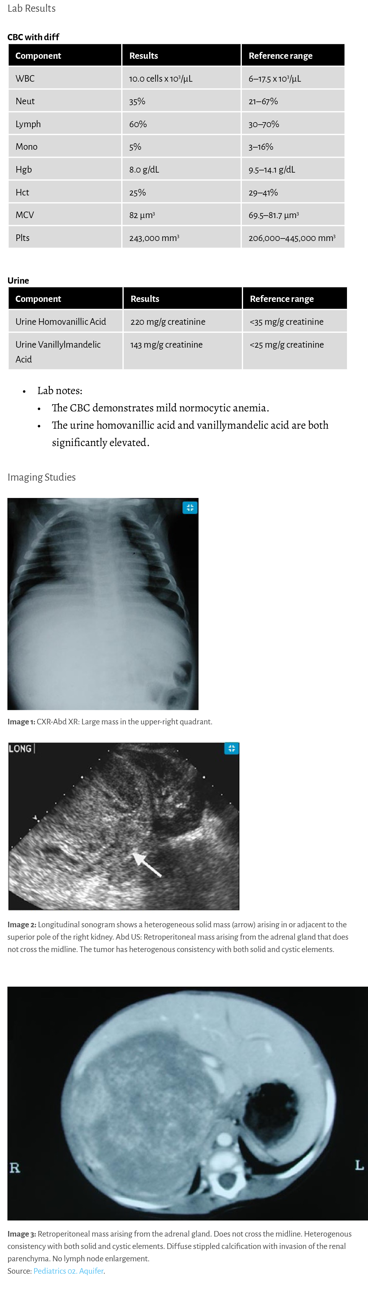 Lab Results CBC with diff Urine • Lab notes: • The CBC demonstrates mild normocytic anemia. • The urine homovanillic ...