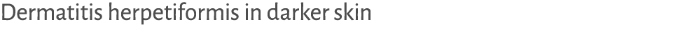 Dermatitis herpetiformis in darker skin